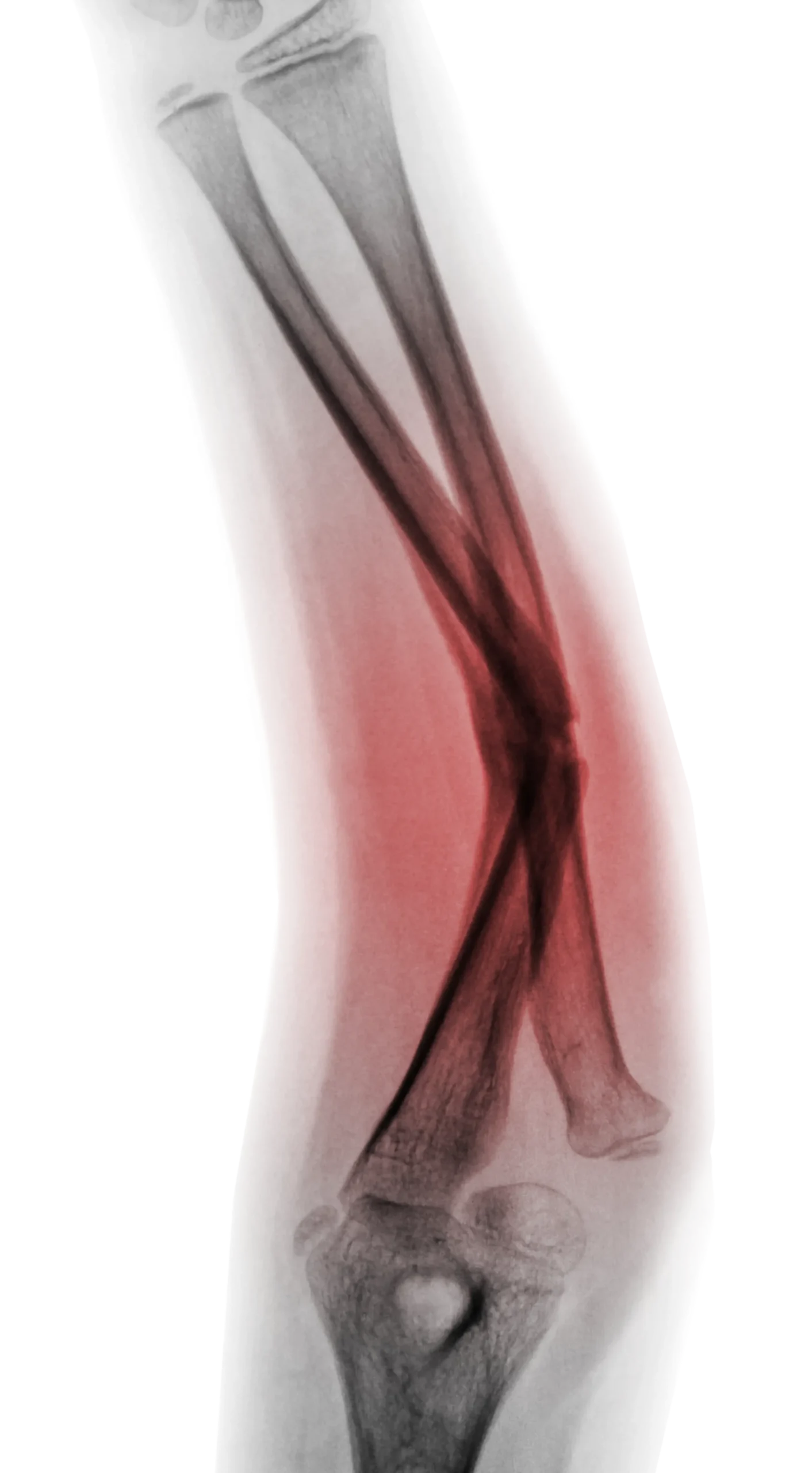 X-ray illustration of an angulated forearm fracture